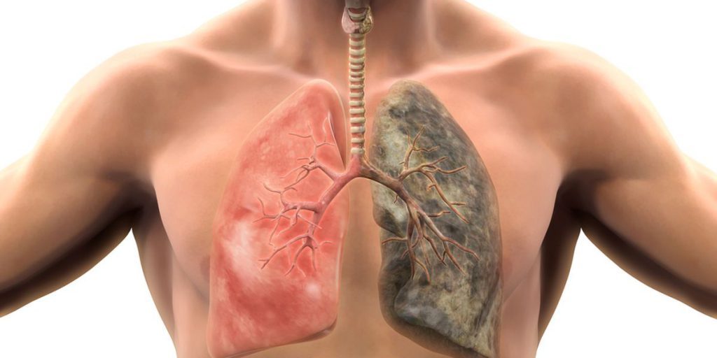 Cáncer de pulmón